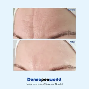 dermapen-05
