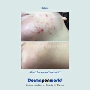 dermapen-06