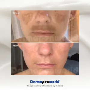 dermapen-07