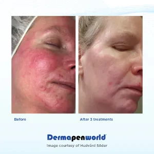 dermapen-08